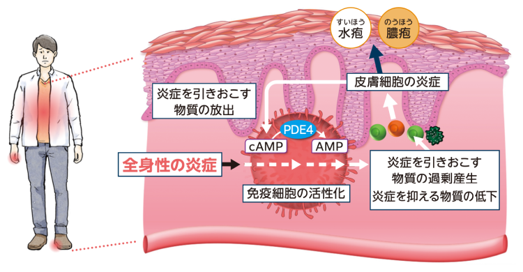 イメージ図：掌蹠膿疱症と全身性の炎症